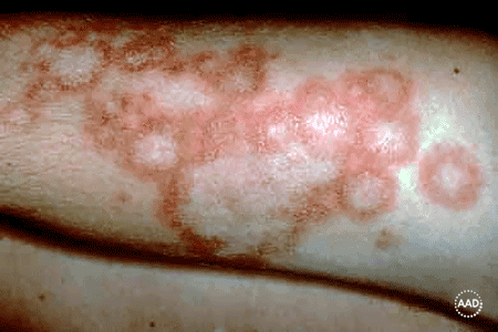 Autoimmune Dermatology