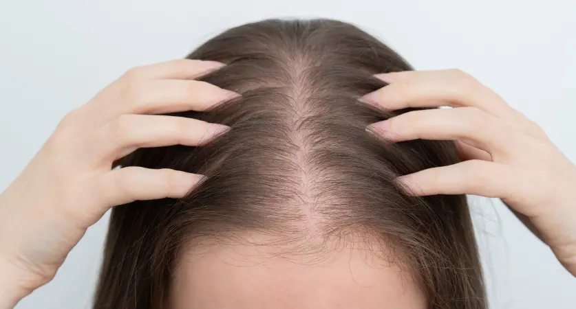 Hair Disorders