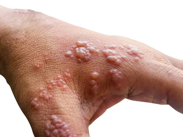 Immunobullous Diseases