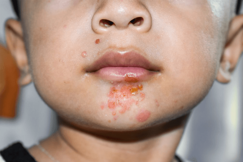 Pediatric Dermatology