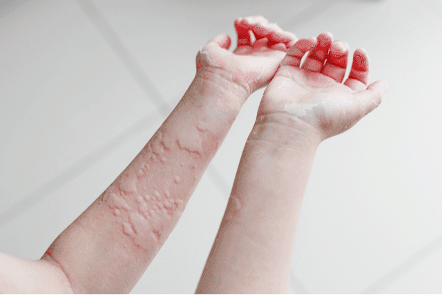 Skin Allergy