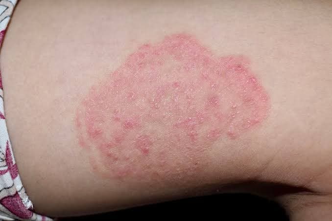 Infections (Fungal, Viral, Parasitic)
