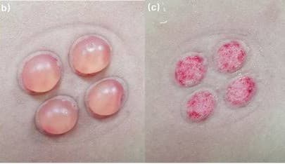 Blister Skin Grafting