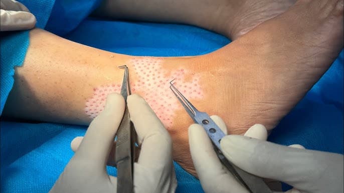 Mini Punch Grafting