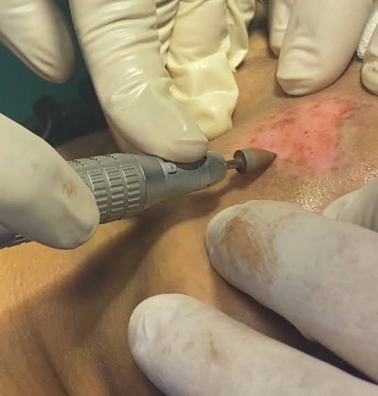 Non-Cultured Epidermal Suspension (NCES)