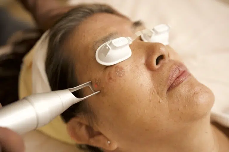 Picofacial Toning