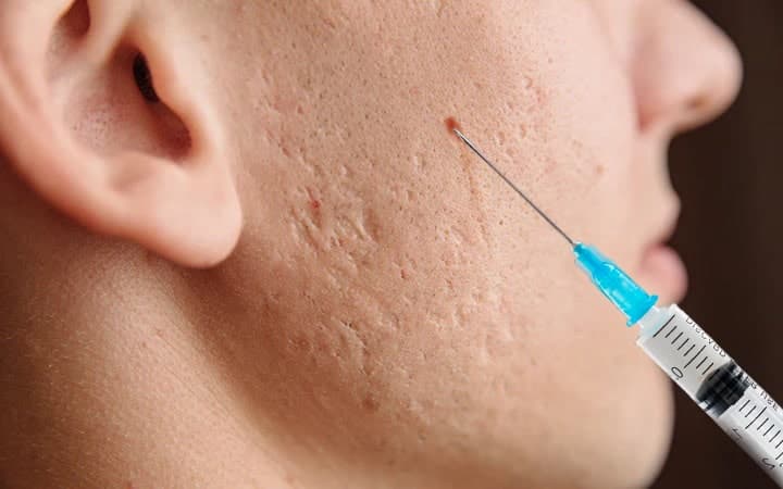 Biofillers for Scars