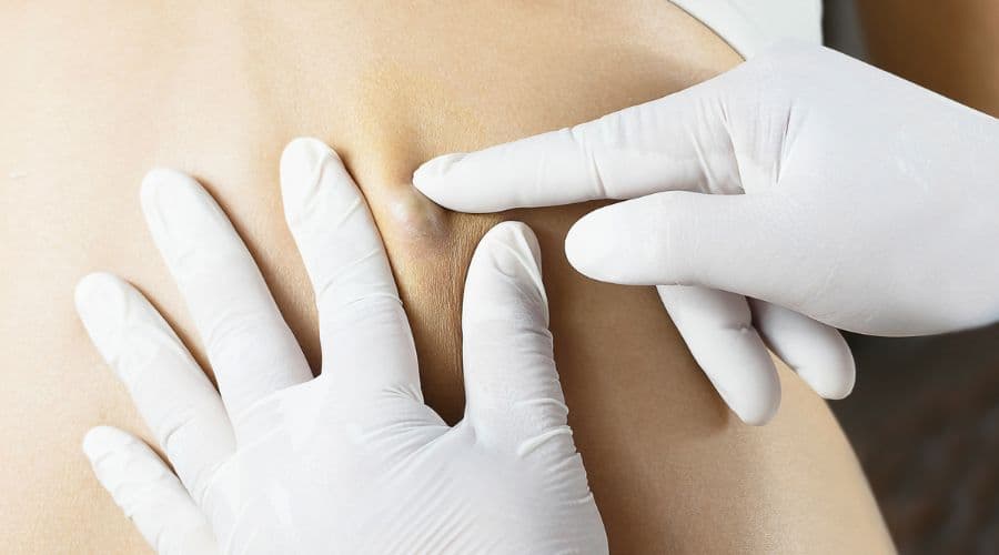 Excision of Lumps & Bumps