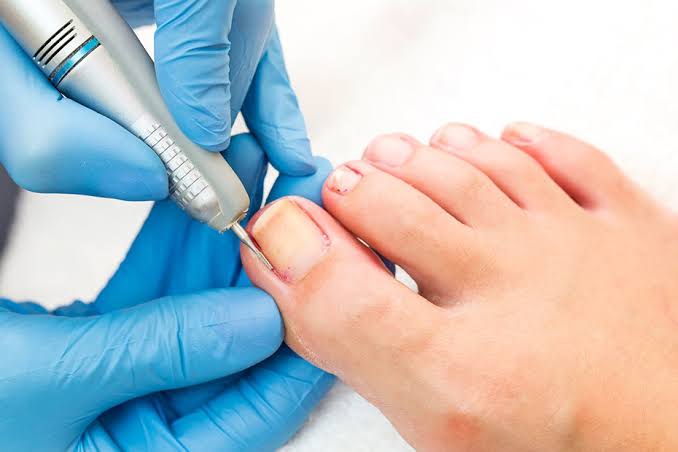 Ingrown Toenail Surgery