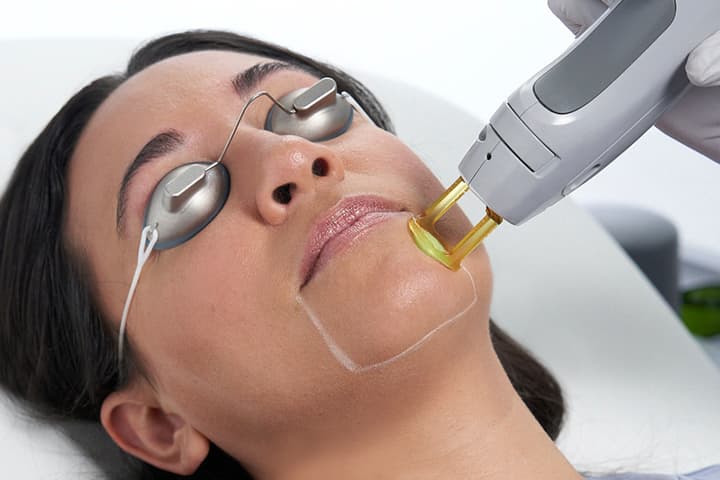 Long Pulsed Nd:YAG Laser