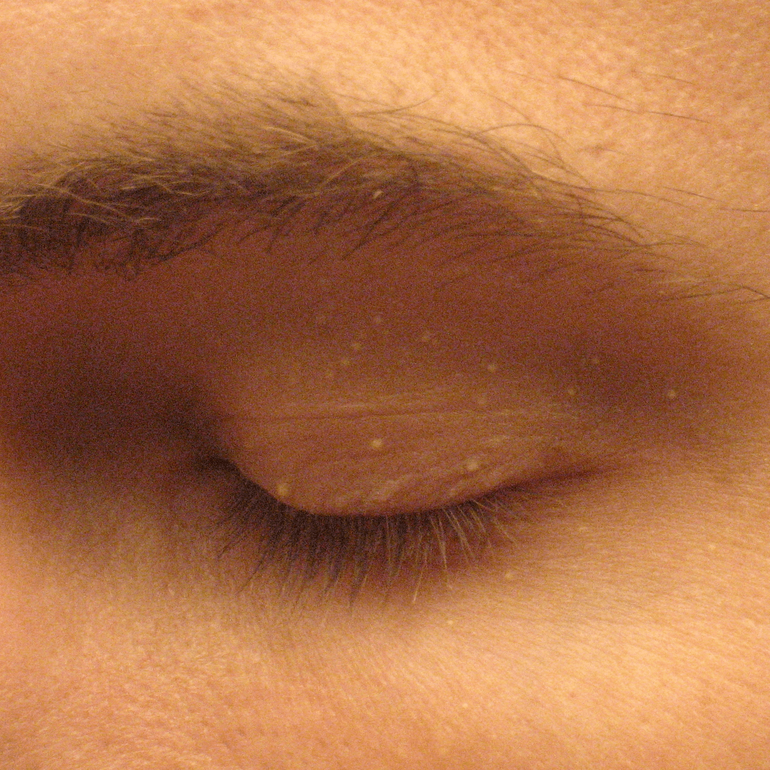 Milia Extraction