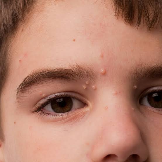 Molluscum Needling