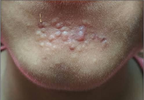 Papular Scar Treatment