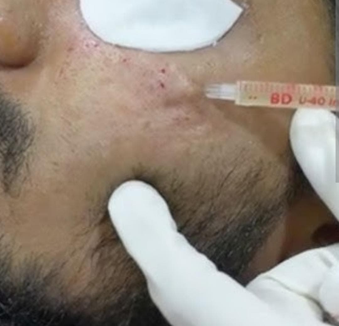 Platelet Rich Plasma for Acne Scars