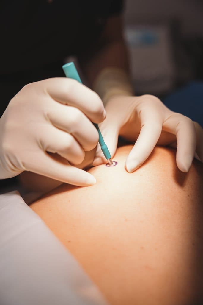 Diagnostic Skin Biopsy
