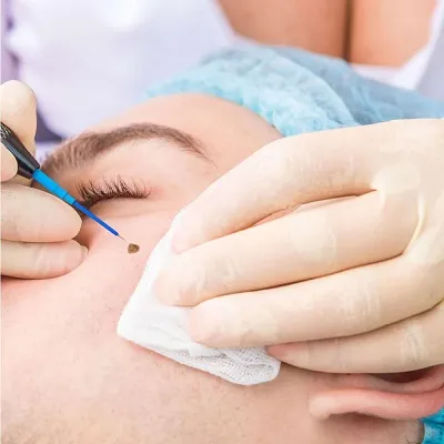Skin Tag Removal