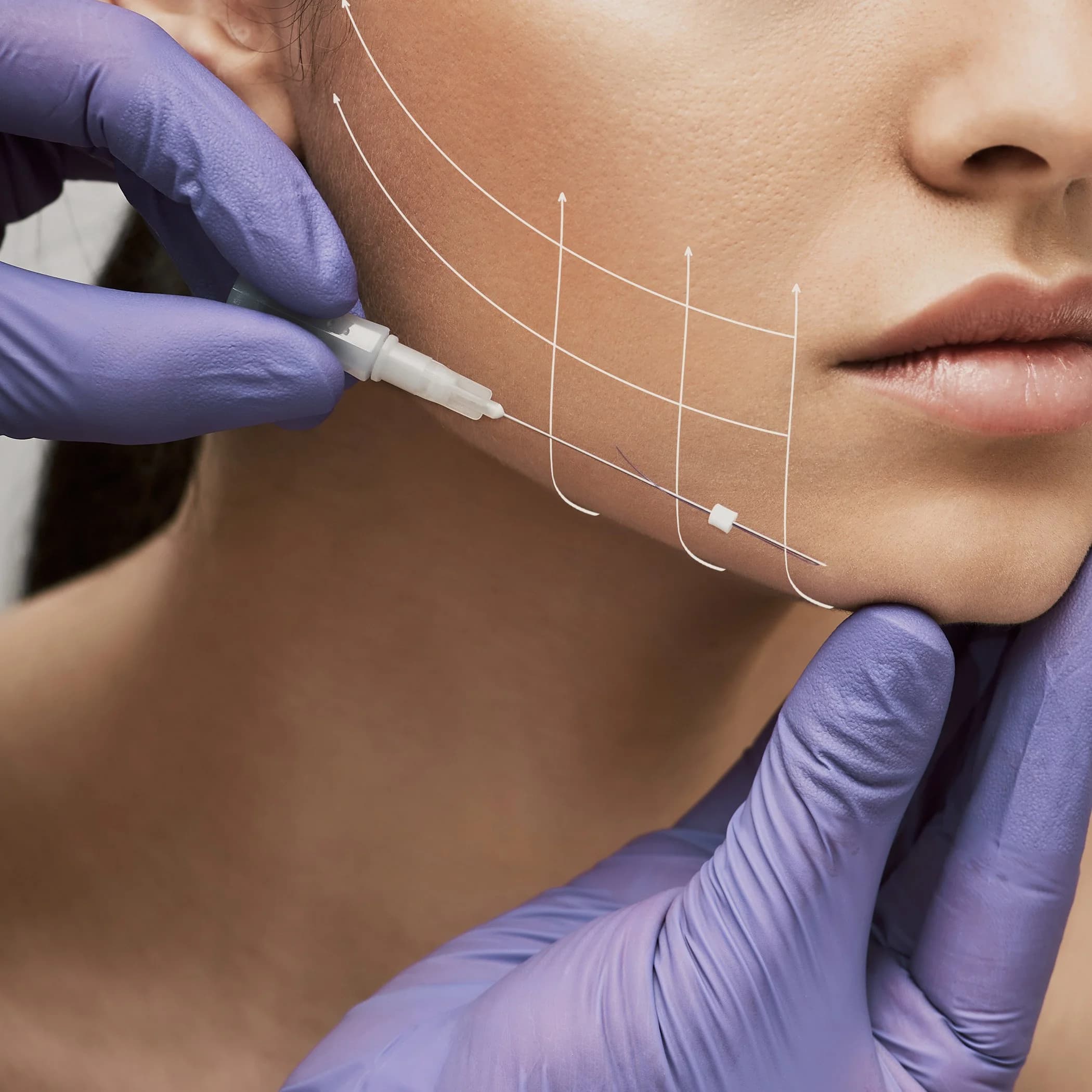Facial Threads for Lifting