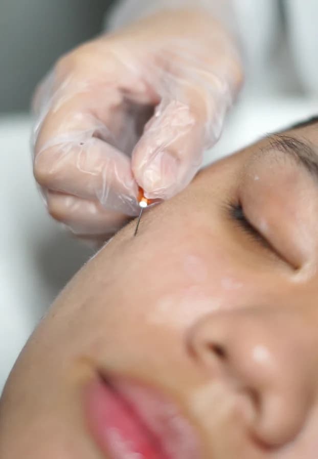 Acne Subcision