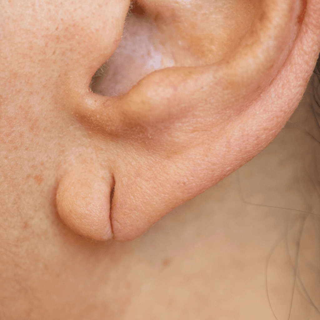 Non-Surgical Ear Lobe Repair