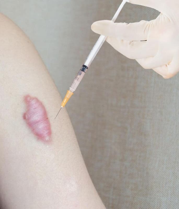 Keloid & Hypertrophic Scar Treatment