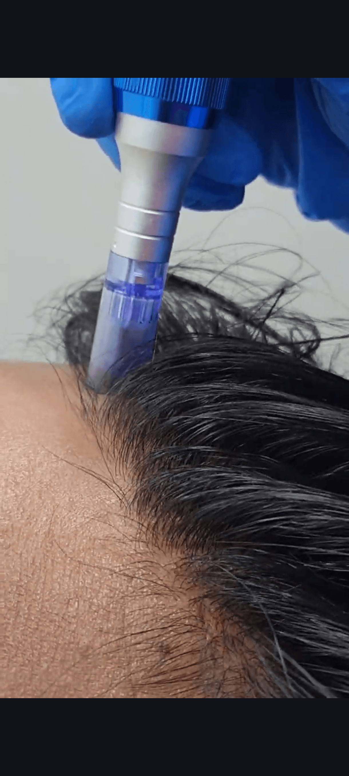 Dutexome Mesotherapy