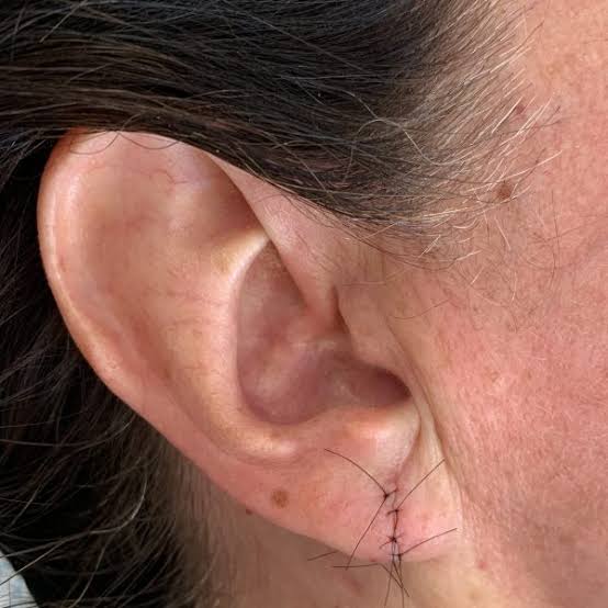 Surgical Ear Lobe Repair