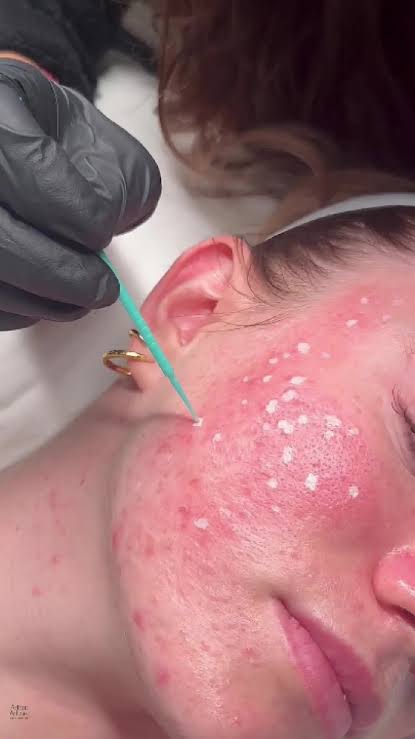 TCA Cross Scar Care