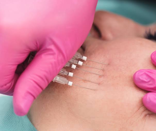 Threads for Acne Scars